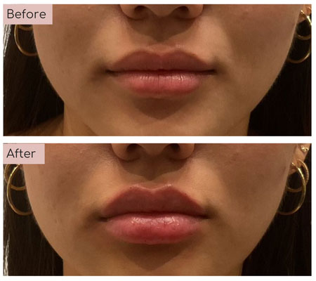 lip fillers before and afters